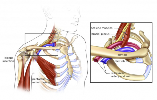 Thoracic Outlet Syndrome TOS